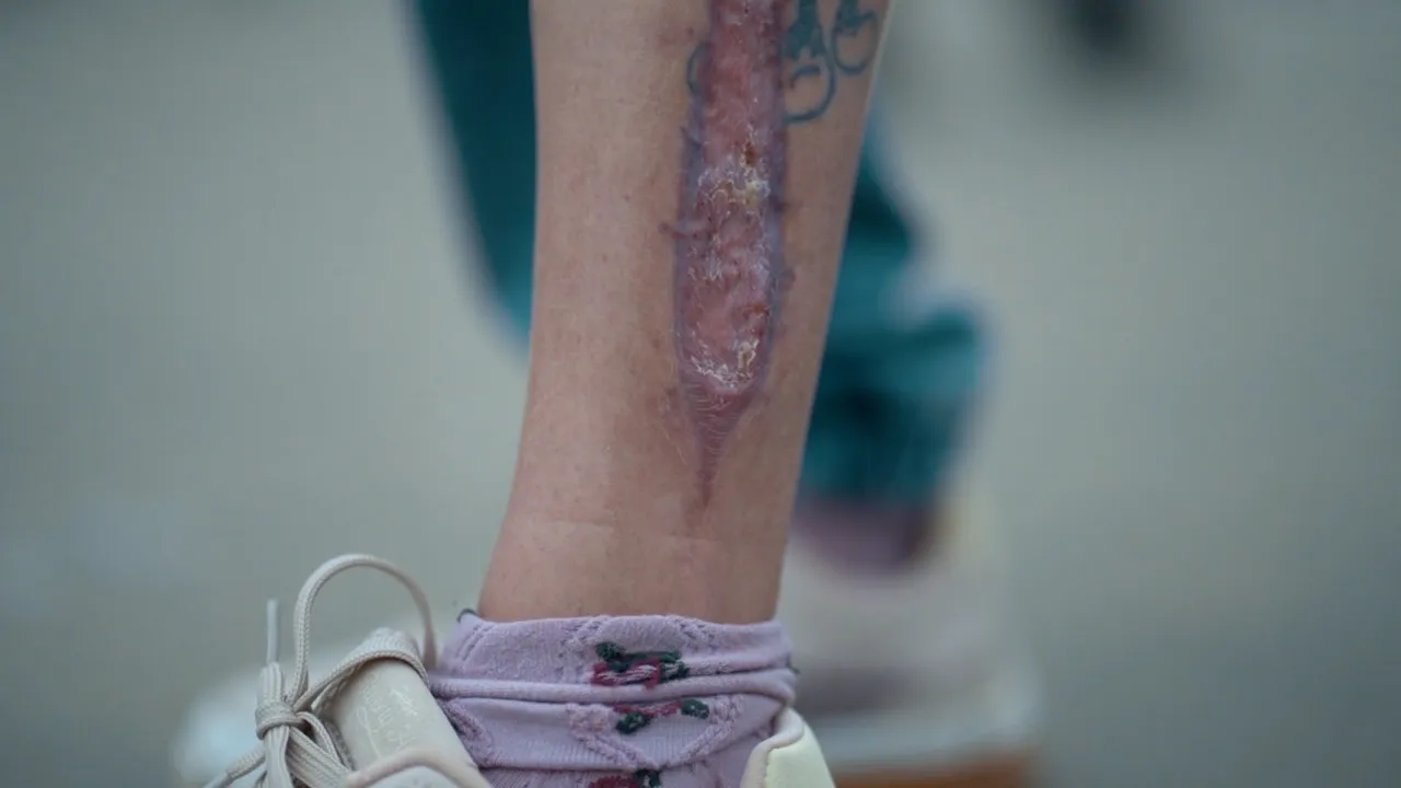 нога после ранения