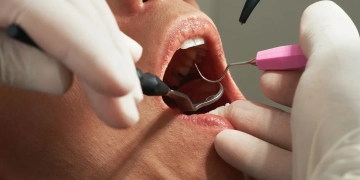 гигиеническая чистка зубов в Польше