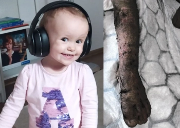 лечение ожогов в Польше